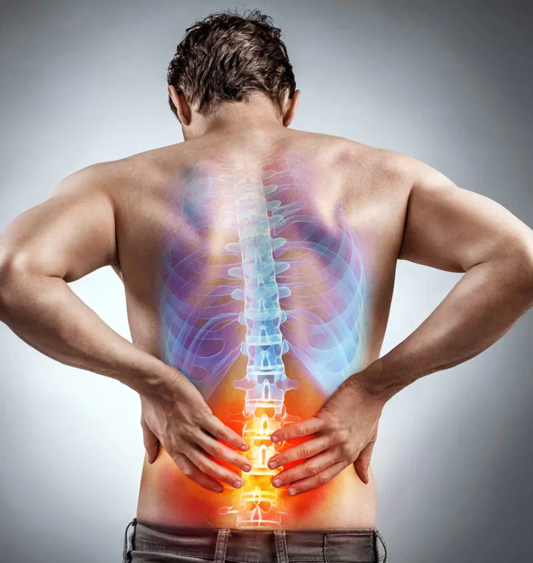 Slipped Herniated Disc Pillars of wellness